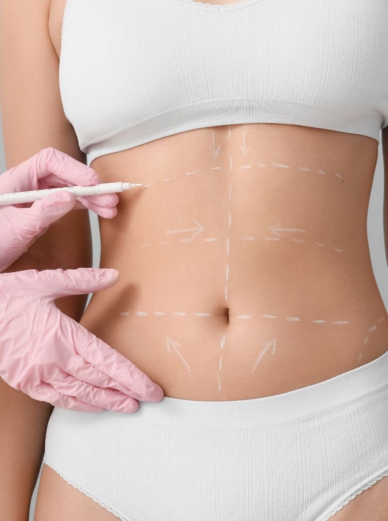 Dra_Alcineide_Recuperação_estética_pós lipoaspiração